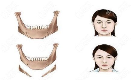 昆明娇点姜宇禄磨骨实例m.8682.cc.jpg