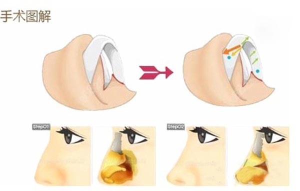 磨骨法做驼峰鼻矫正改善