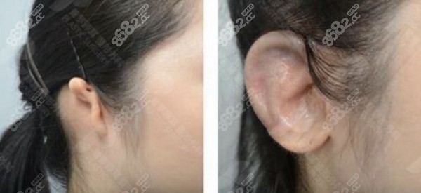 在普罗菲耳整形外科做耳整形的优势