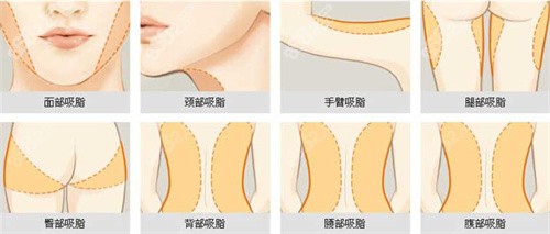 王志军医生多维立体吸脂法技术优势