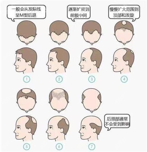 头发脱落的自然轨迹图