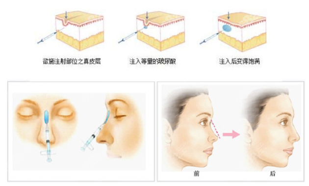 宁波艺星整形医院玻尿酸隆鼻多少钱