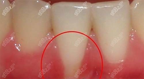 牙周治疗后牙龈萎缩会恢复吗？牙周治疗一般几次才算完