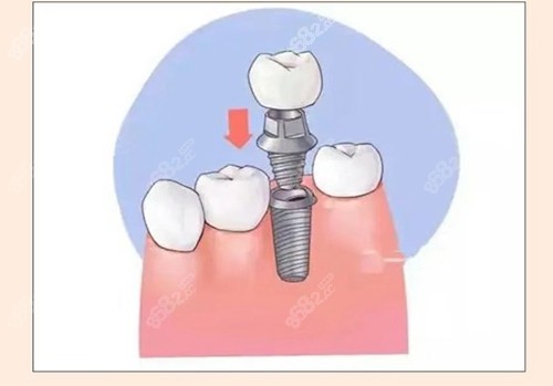 银川口腔医院种植牙