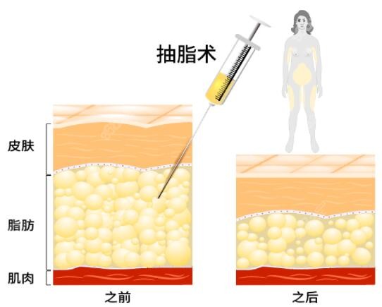 石家庄雅芳亚吸脂怎么样