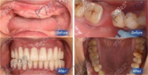 张笑卿医生种植牙修复对比照 张笑卿医生种植牙修复对比照