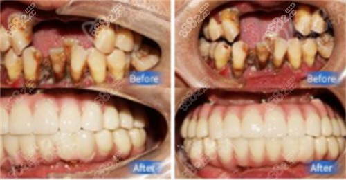 林峰医生种植牙前后对比照片 林峰医生种植牙前后对比照片