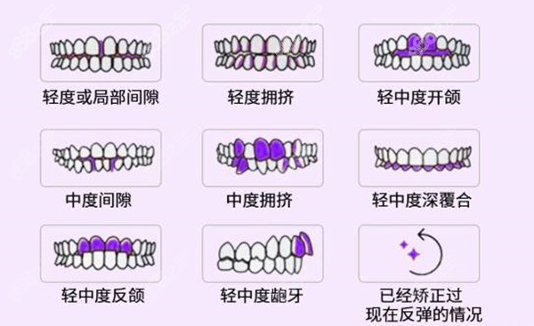 <!--<i data=20240705-sp></i>-->口腔牙齿矫正类型