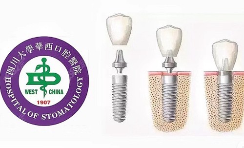 国产CDIC种植牙