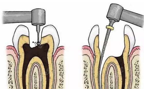 根管过的牙