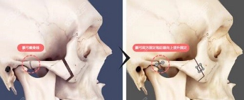 李志海做磨骨手术好吗