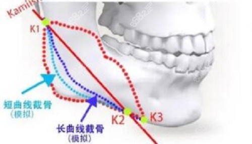 李志海长曲线下颌角