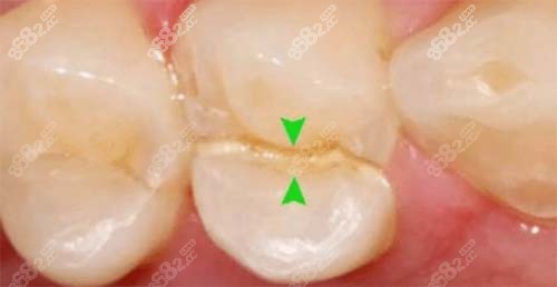 根管过的牙裂了