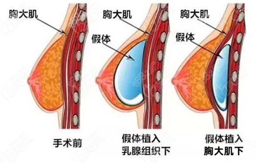 杭州艺星假体丰胸技术