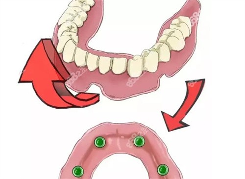 金华口腔医院半口种植牙价格表