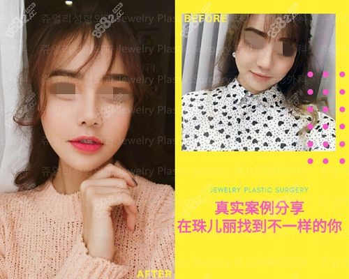 韩国珠儿丽整形外科下颌角手术对比
