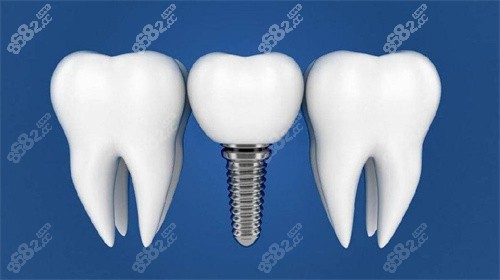 成都种植牙一颗价格是多少 成都种植牙一颗价格是多少