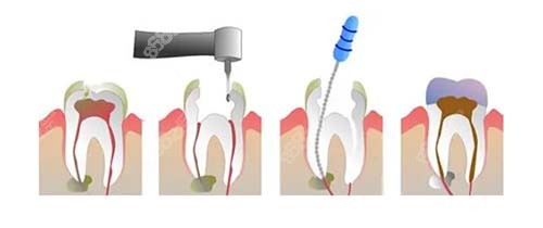 根管治疗的步骤