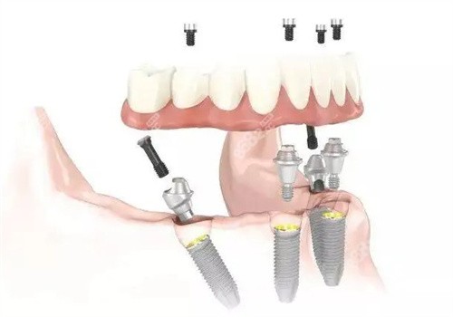金华口腔医院种植牙价格表