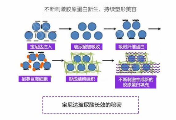 宝尼达维持十年要注射几次