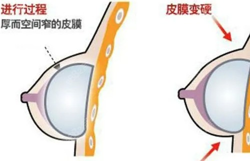 包膜孪缩的表现