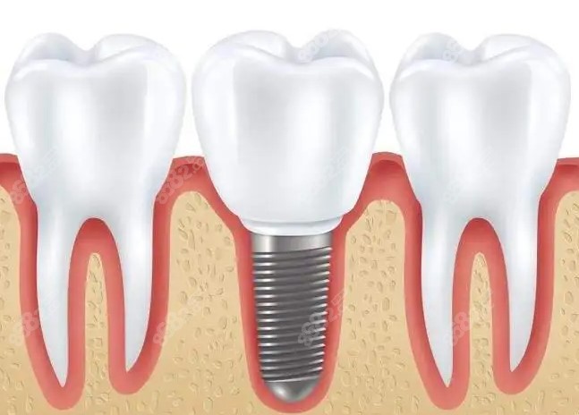 淮南种植牙多少钱一颗2023价格表