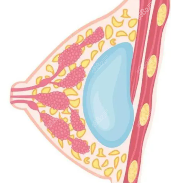 假体隆胸手术