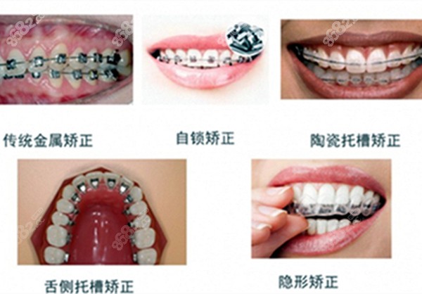 牙齿矫正器的类型图