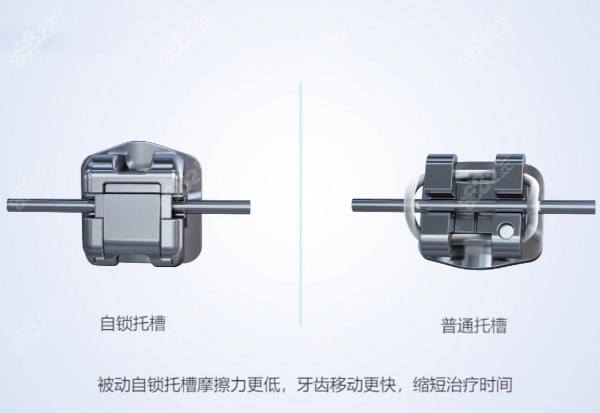 普通托槽和自锁托槽对比图