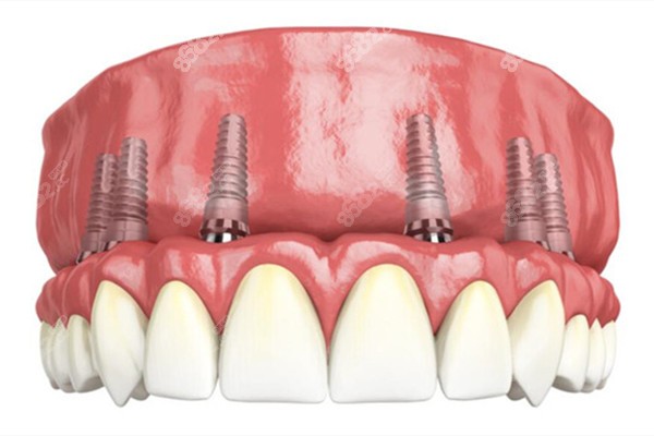 2023罗湖区全口种植牙价格