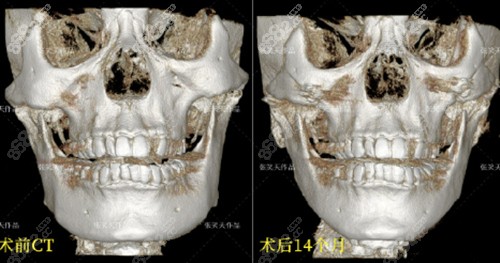 张笑天面部轮廓手术前后对比照