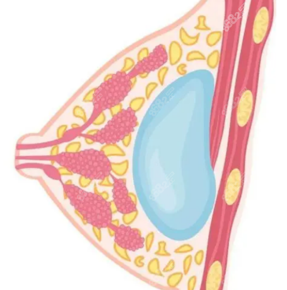假体隆胸手术