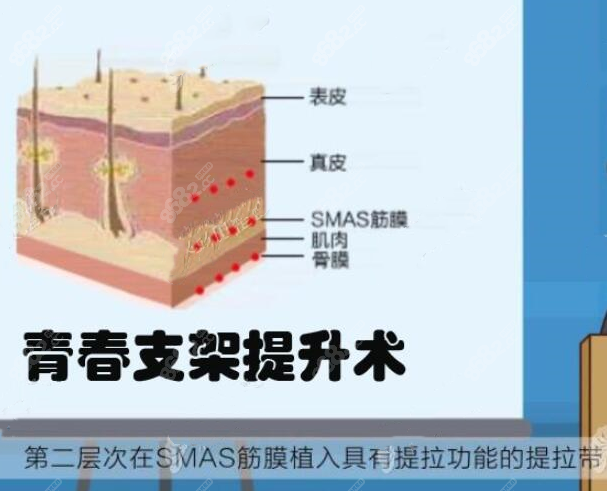 青春肽支架提升术