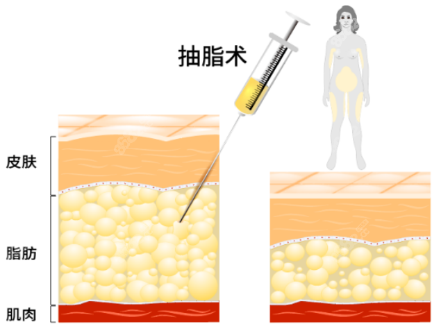 吸脂手术