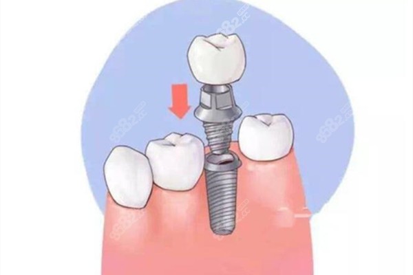 2023深圳罗湖区种植牙价格表