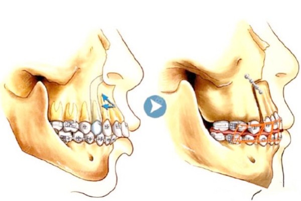 正颌手术在牙不齐的情况下可以做吗