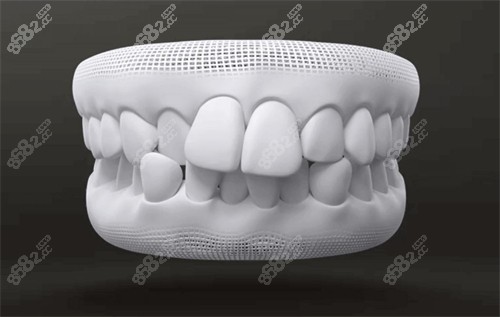 牙齿畸形动画图