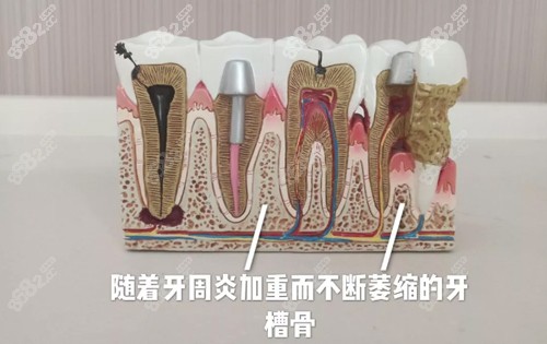 牙周炎对于牙槽骨的影响图