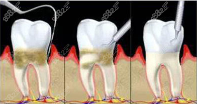 牙龈下结石必须清除吗？www.8682.cc