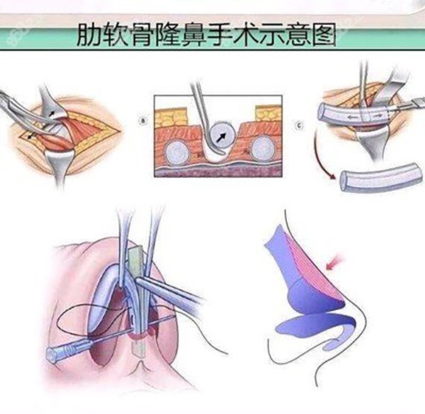 肋骨隆鼻手术过程
