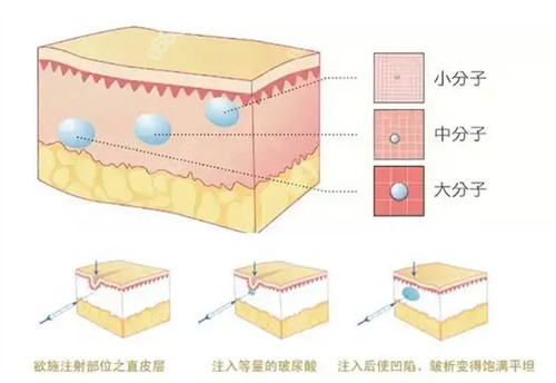 富娜医生玻尿酸注射技术强劲