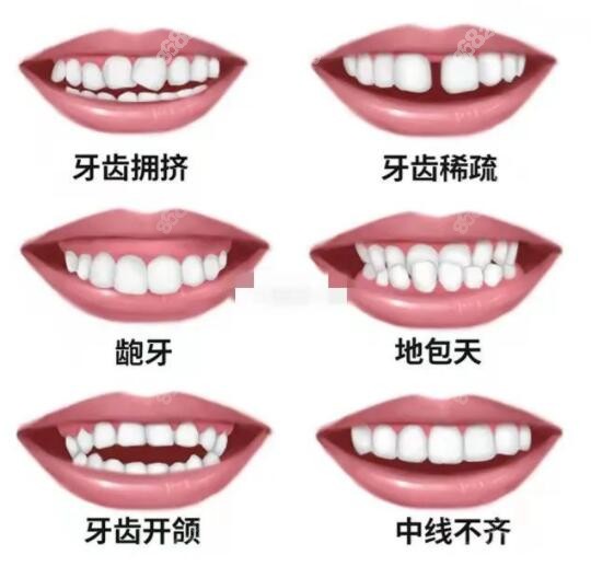 牙齿矫正需要多少钱