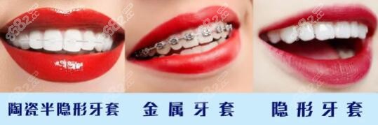 2023年牙齿矫正金属/隐形牙套费用表