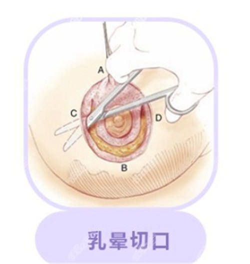 深圳南雅何奇乳房花苞提升有啥优势？