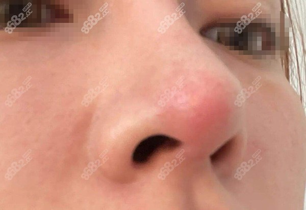 肋骨隆鼻鼻尖发红需要修复么