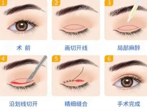 广州双眼皮修复好的医生及价格