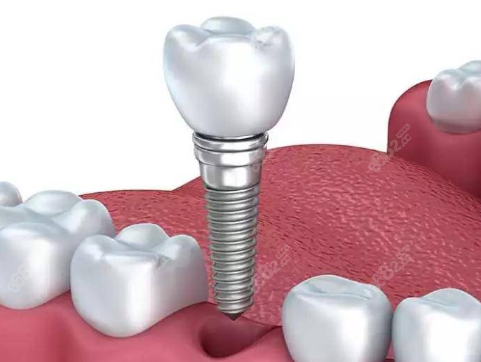 种植牙一拖二的利与弊分析