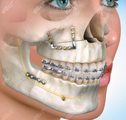正颌手术过程图示8682.c