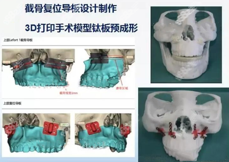 何晋龙3D数字化颌面外科技术