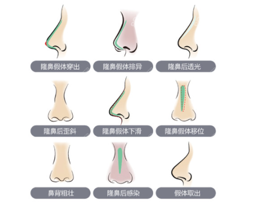 南宁隆鼻修复哪家医院好